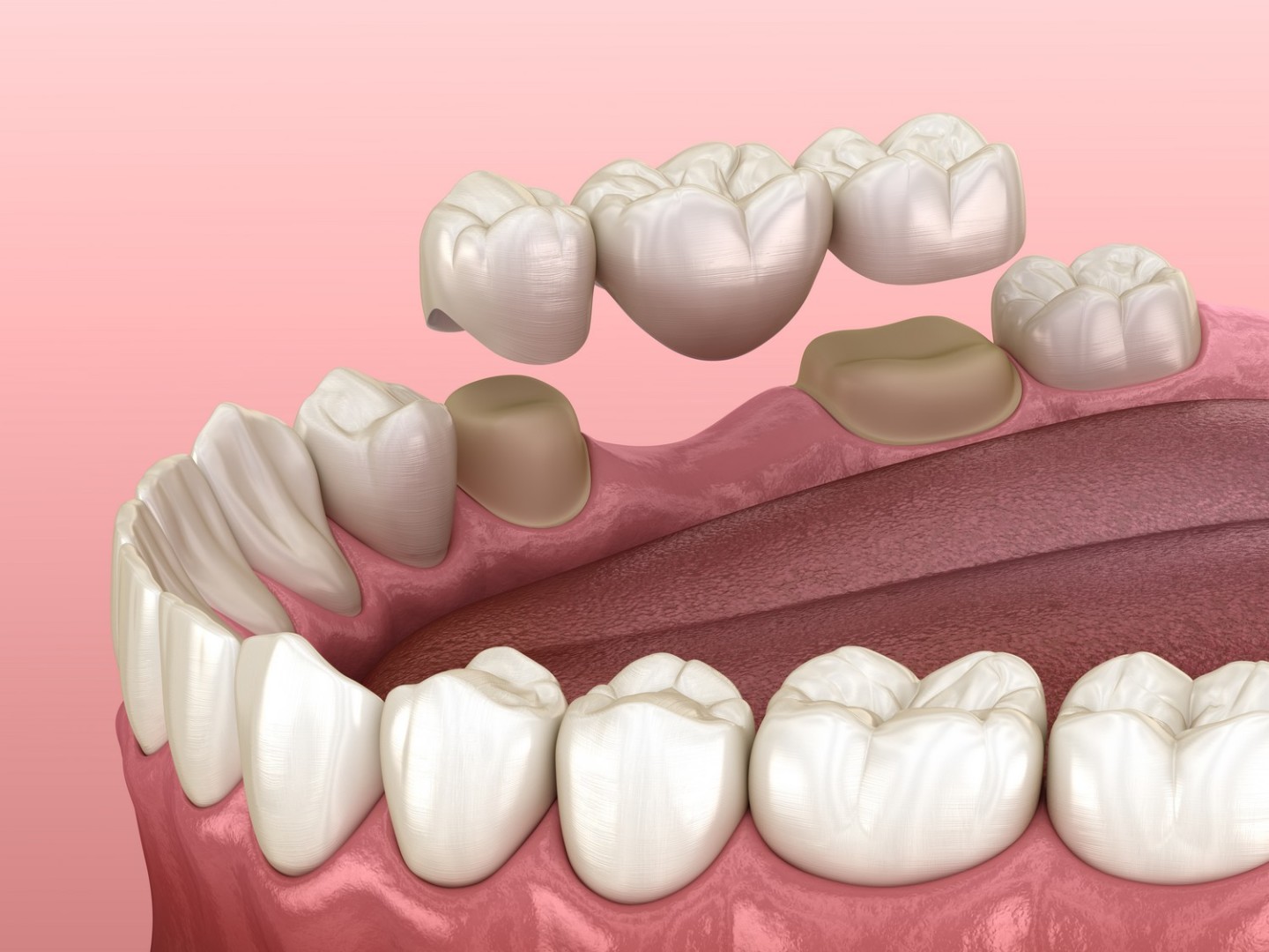 Implants, Couronnes et Ponts Dentaires