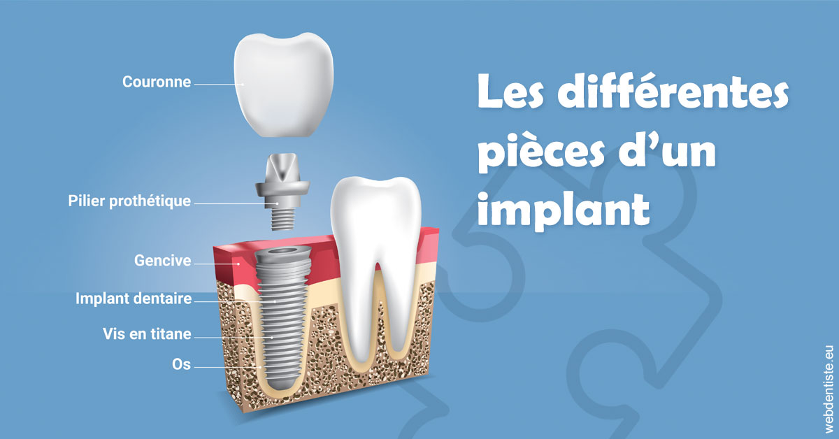 https://www.clinilac.ch/Les différentes pièces d’un implant 1