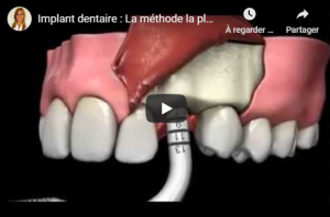 Pose implant dentaire